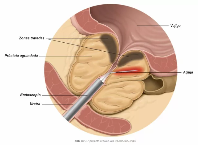Pygeum: El suplemento dietético revolucionario para la salud de la próstata
